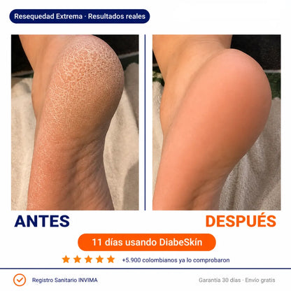 DiabeSkin | Ultrahumectante