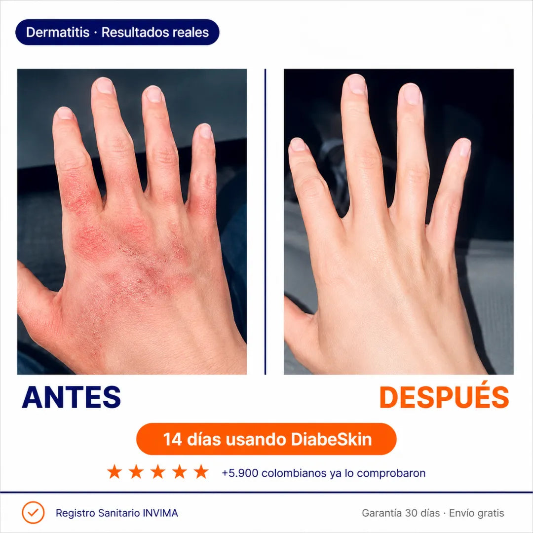 DiabeSkin | Ultrahumectante